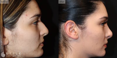 Rhinoplasty Before & After Gallery - Patient 339860 - Image 1