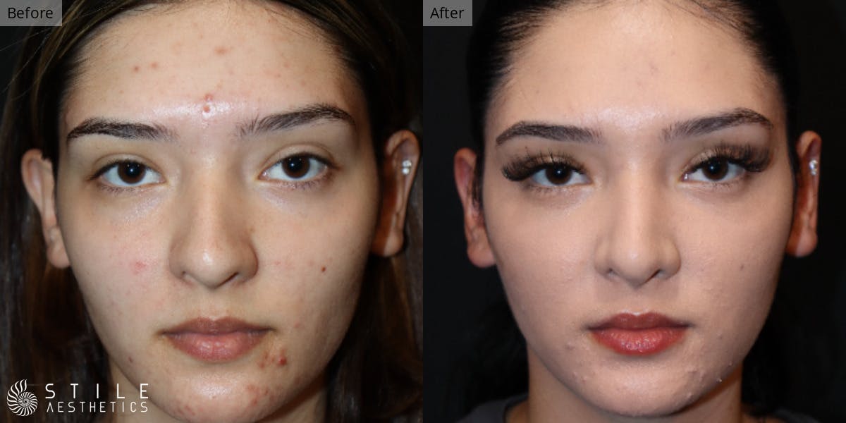Rhinoplasty Before & After Gallery - Patient 339860 - Image 2