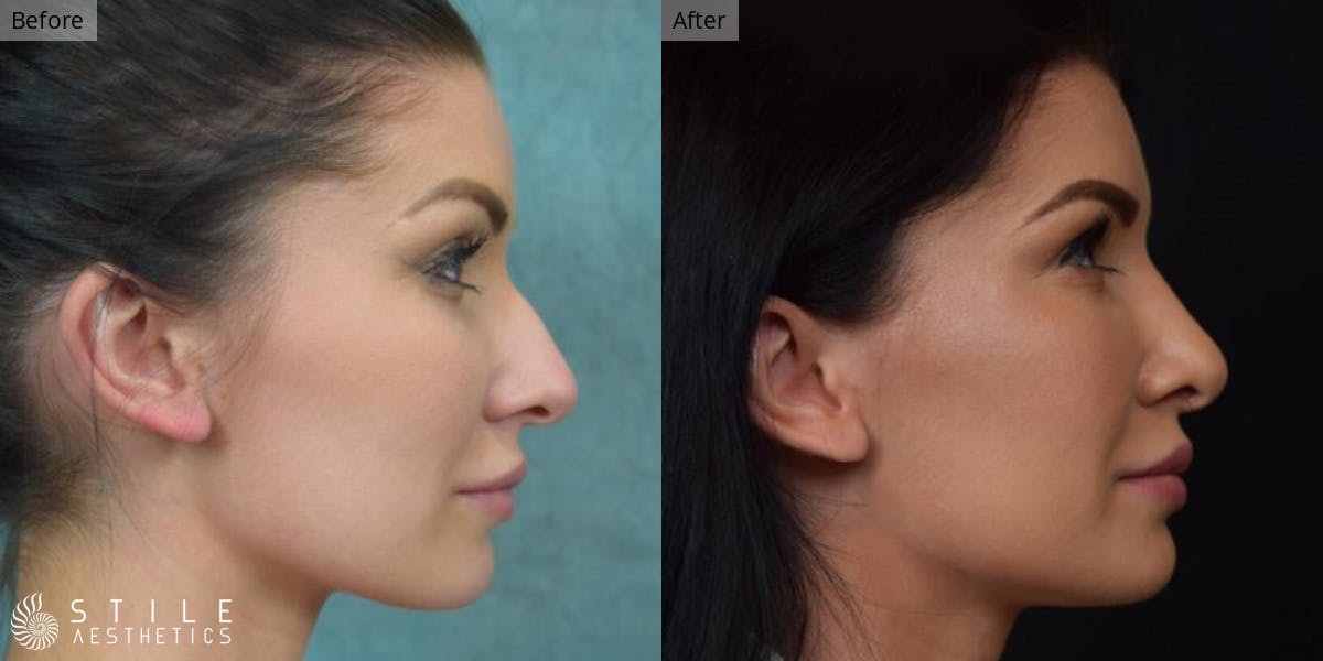 Rhinoplasty Before & After Gallery - Patient 253956 - Image 1