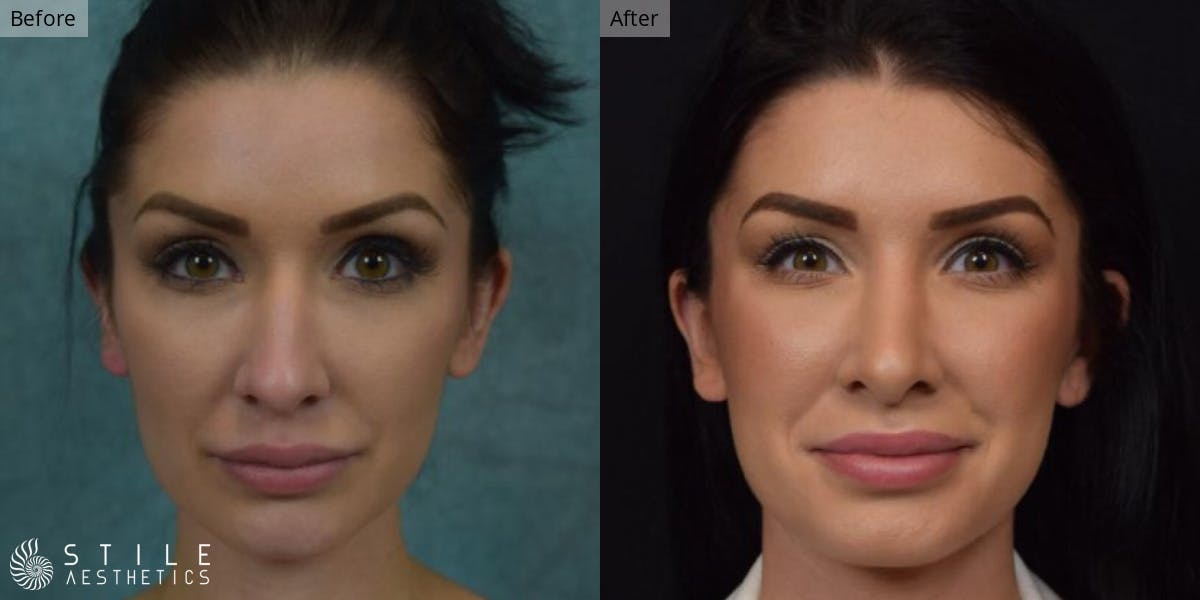 Rhinoplasty Before & After Gallery - Patient 253956 - Image 2