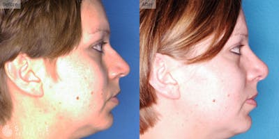 Rhinoplasty Before & After Gallery - Patient 324914 - Image 1