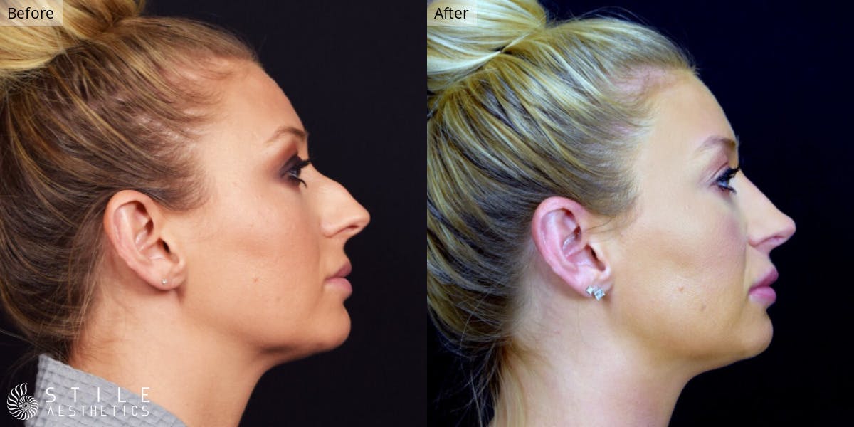 Rhinoplasty Before & After Gallery - Patient 107477 - Image 1