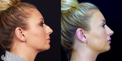 Rhinoplasty Before & After Gallery - Patient 107477 - Image 1