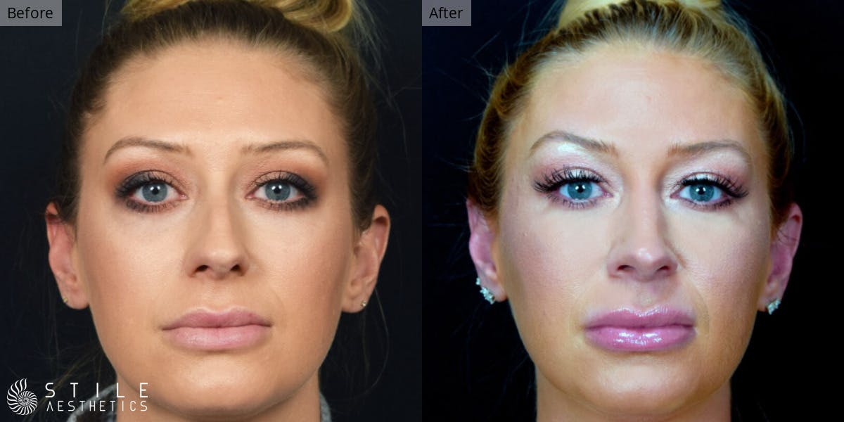 Rhinoplasty Before & After Gallery - Patient 107477 - Image 2