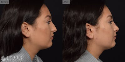 Rhinoplasty Before & After Gallery - Patient 212733 - Image 1