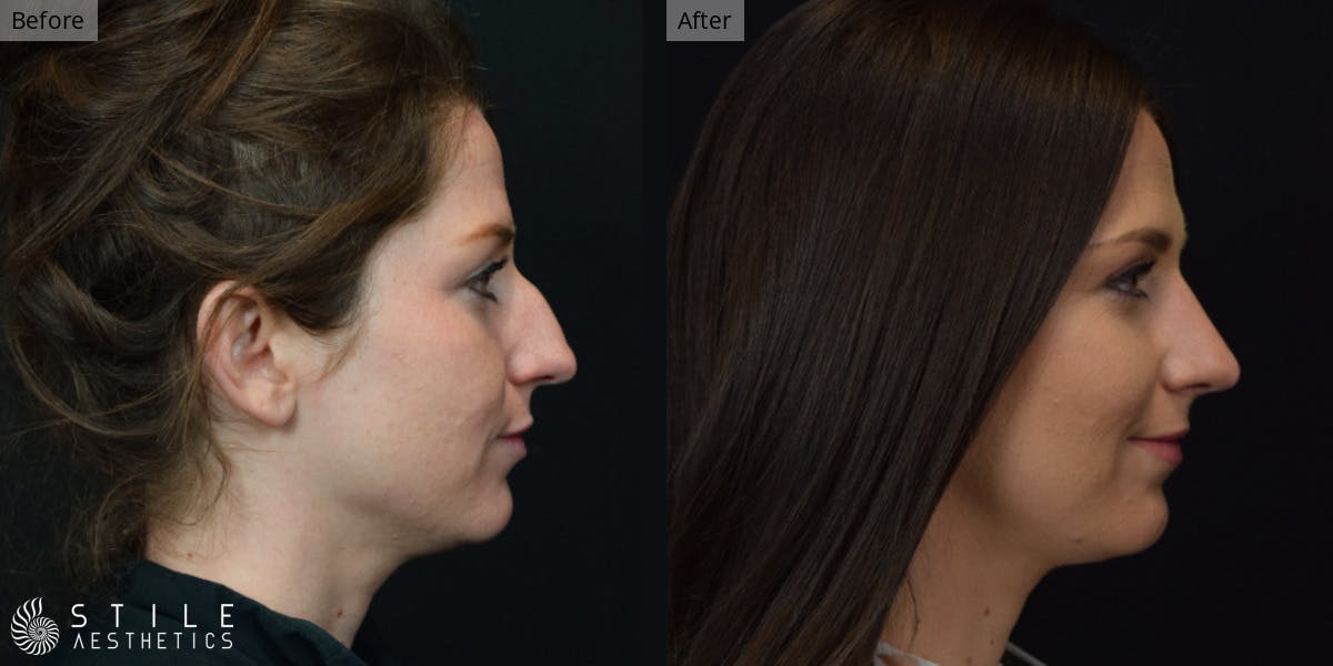 Rhinoplasty Before & After Gallery - Patient 339289 - Image 1