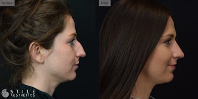 Rhinoplasty Before & After Gallery - Patient 339289 - Image 1