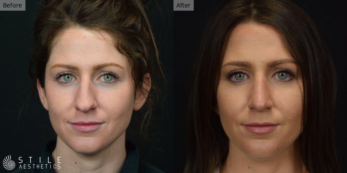Rhinoplasty Before & After Gallery - Patient 339289 - Image 2