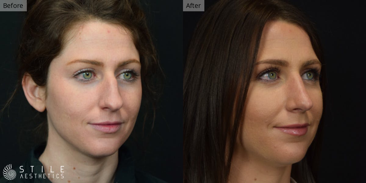 Rhinoplasty Before & After Gallery - Patient 339289 - Image 3