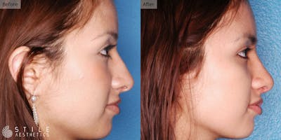 Rhinoplasty Before & After Gallery - Patient 142493 - Image 1