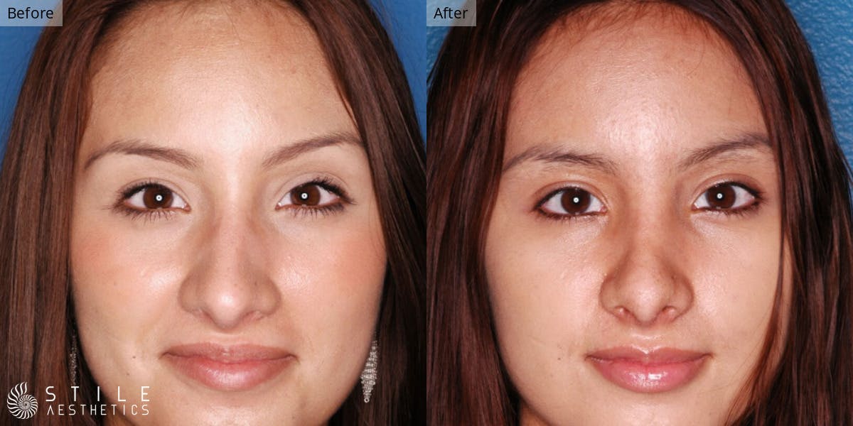 Rhinoplasty Before & After Gallery - Patient 142493 - Image 2