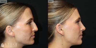Rhinoplasty Before & After Gallery - Patient 177467 - Image 1