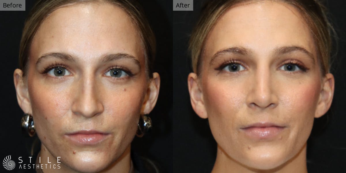 Rhinoplasty Before & After Gallery - Patient 177467 - Image 2