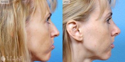 Rhinoplasty Before & After Gallery - Patient 897736 - Image 1