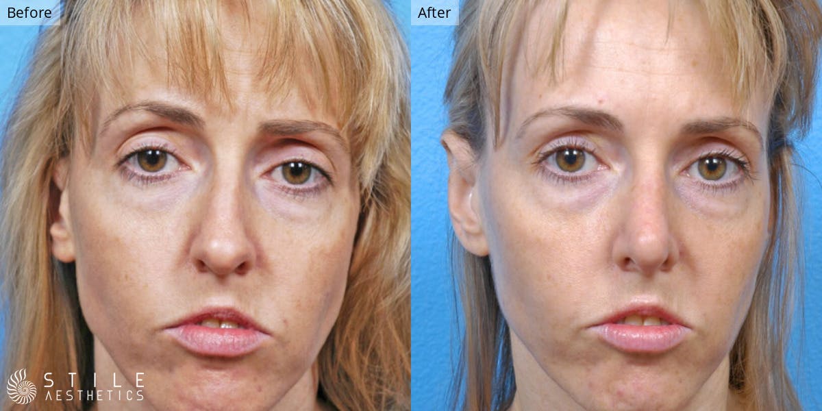 Rhinoplasty Before & After Gallery - Patient 897736 - Image 2
