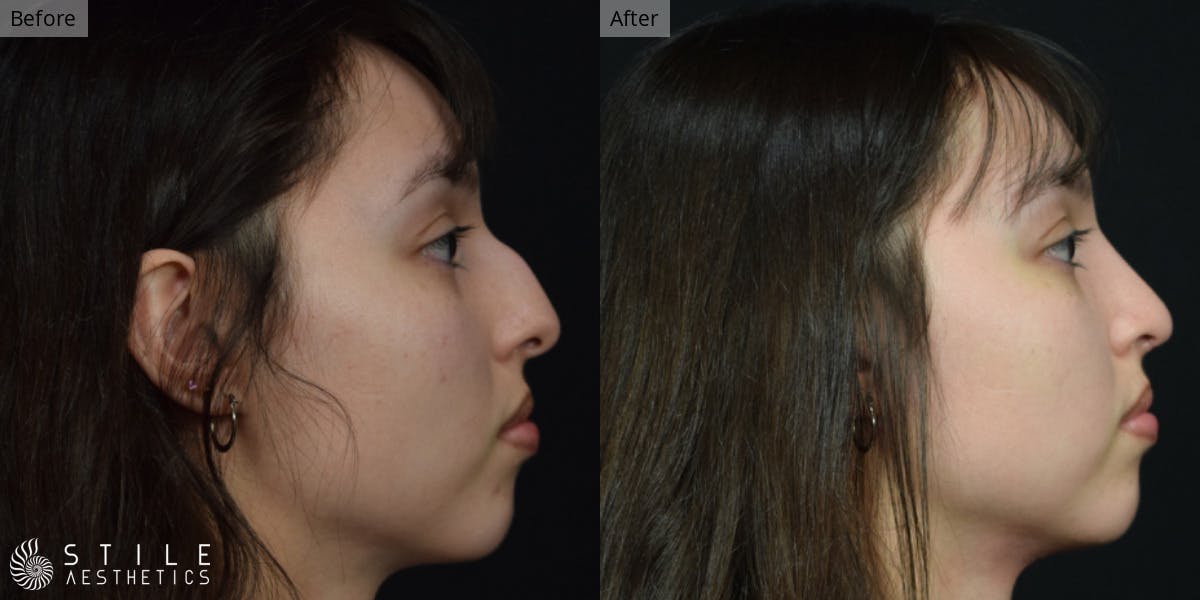Rhinoplasty Before & After Gallery - Patient 375535 - Image 1