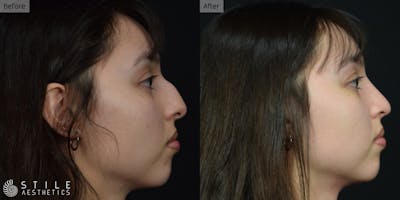 Rhinoplasty Before & After Gallery - Patient 375535 - Image 1