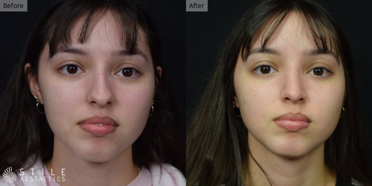 Rhinoplasty Before & After Gallery - Patient 375535 - Image 2