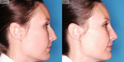 Rhinoplasty Before & After Gallery - Patient 233969 - Image 1