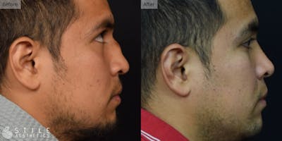 Rhinoplasty Before & After Gallery - Patient 582156 - Image 1