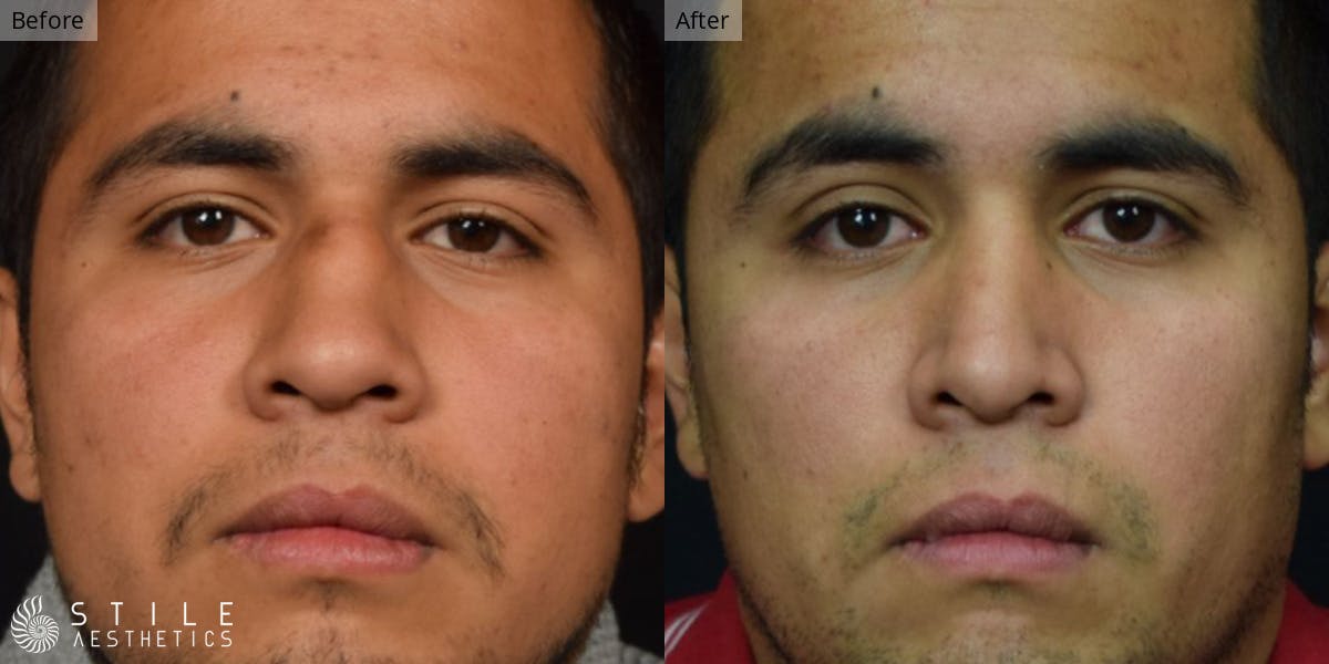 Rhinoplasty Before & After Gallery - Patient 582156 - Image 2