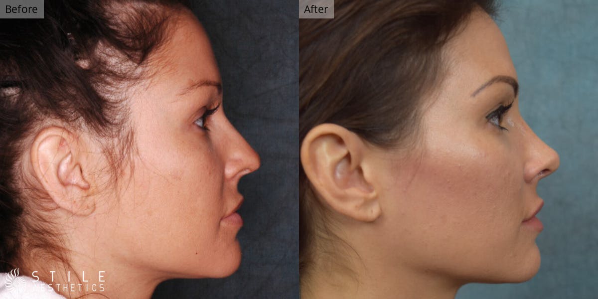 Rhinoplasty Before & After Gallery - Patient 126956 - Image 1