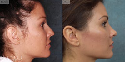 Rhinoplasty Before & After Gallery - Patient 126956 - Image 1