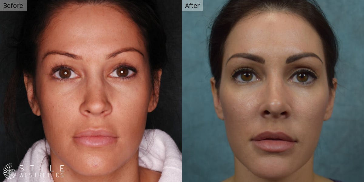 Rhinoplasty Before & After Gallery - Patient 126956 - Image 2