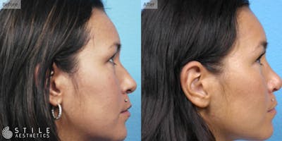 Rhinoplasty Before & After Gallery - Patient 385569 - Image 1