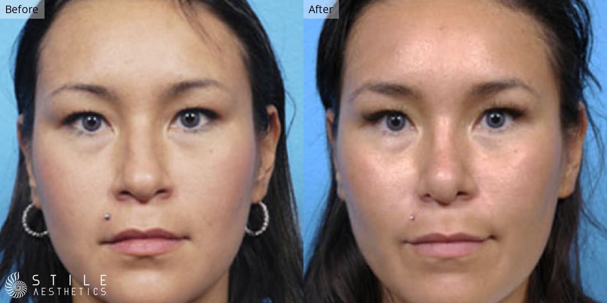 Rhinoplasty Before & After Gallery - Patient 385569 - Image 2