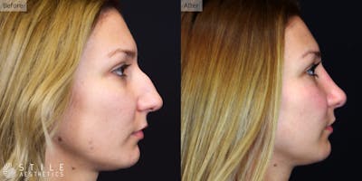 Rhinoplasty Before & After Gallery - Patient 330906 - Image 1
