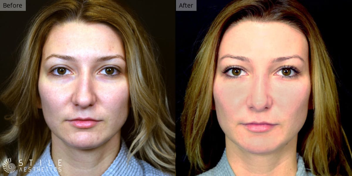 Rhinoplasty Before & After Gallery - Patient 330906 - Image 2