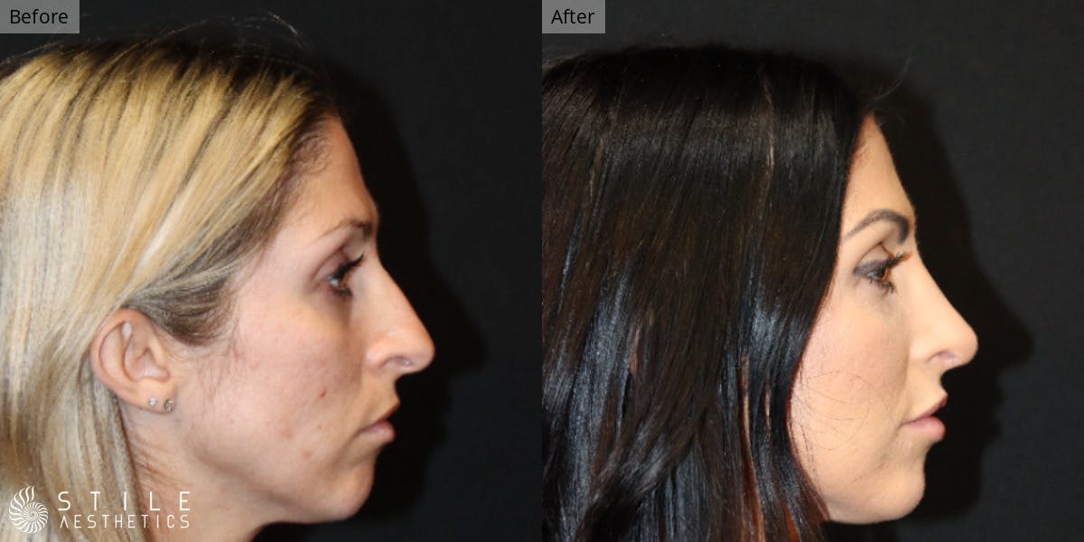 Rhinoplasty Before & After Gallery - Patient 230720 - Image 1