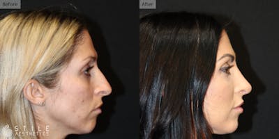 Rhinoplasty Before & After Gallery - Patient 230720 - Image 1