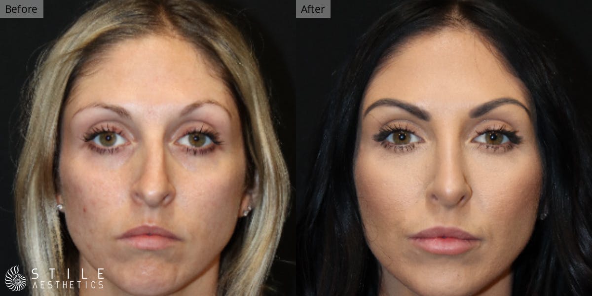 Rhinoplasty Before & After Gallery - Patient 230720 - Image 2