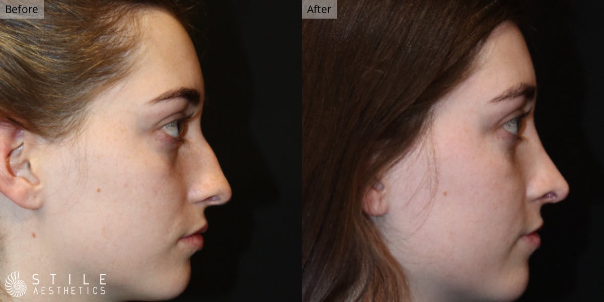 Rhinoplasty Before & After Gallery - Patient 511322 - Image 1
