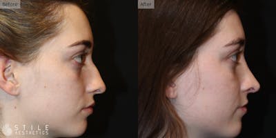 Rhinoplasty Before & After Gallery - Patient 511322 - Image 1