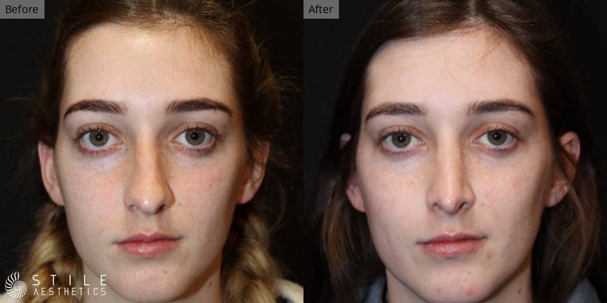 Rhinoplasty Before & After Gallery - Patient 511322 - Image 2