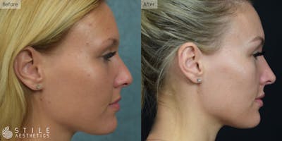 Rhinoplasty Before & After Gallery - Patient 276208 - Image 1