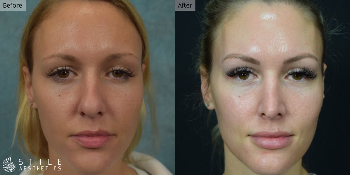 Rhinoplasty Before & After Gallery - Patient 276208 - Image 2