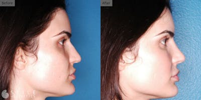 Rhinoplasty Before & After Gallery - Patient 200912 - Image 1