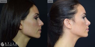 Rhinoplasty Before & After Gallery - Patient 246537 - Image 1