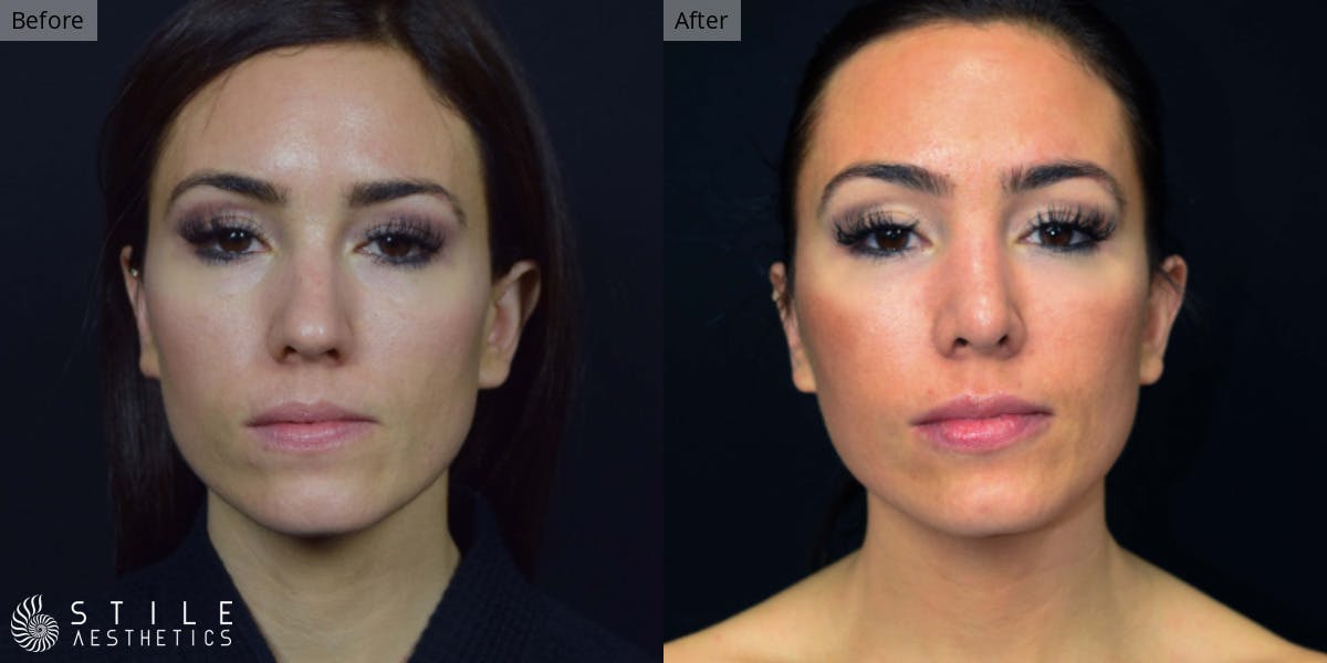 Rhinoplasty Before & After Gallery - Patient 246537 - Image 2