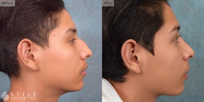 Rhinoplasty Before & After Gallery - Patient 266315 - Image 1