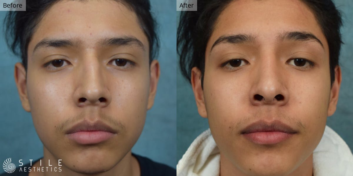 Rhinoplasty Before & After Gallery - Patient 266315 - Image 2