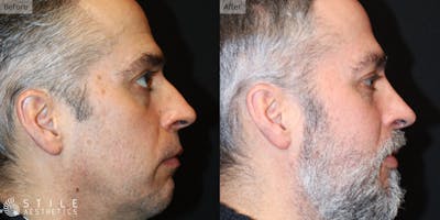 Rhinoplasty Before & After Gallery - Patient 141878 - Image 1