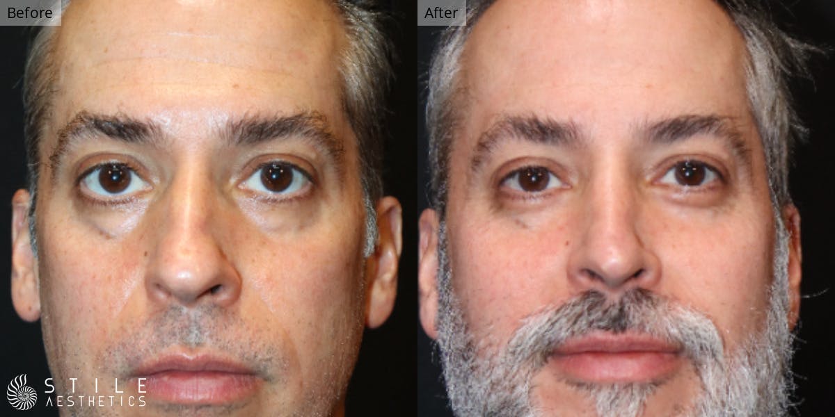 Rhinoplasty Before & After Gallery - Patient 141878 - Image 2