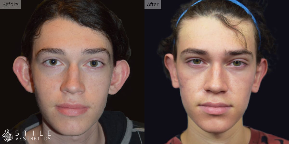 Otoplasty Before & After Gallery - Patient 142424 - Image 1