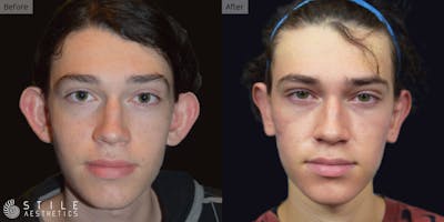 Otoplasty Before & After Gallery - Patient 142424 - Image 1
