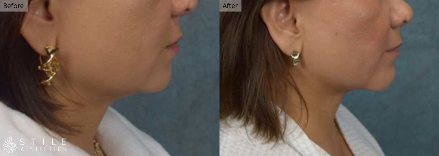 Chin Augmentation Before & After Gallery - Patient 278327 - Image 1